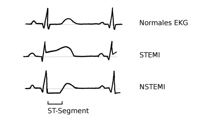 EKG Herzinfarkt