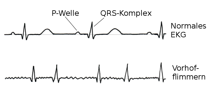 EKG: Vorhofflimmern