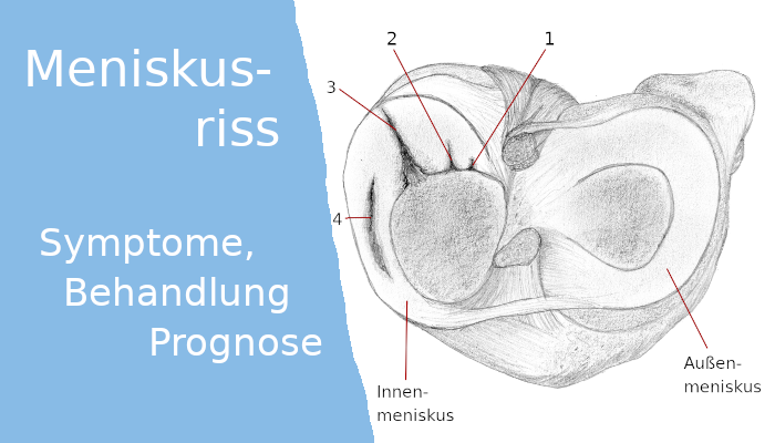 Meniskusriss: Symptome, Behandlung, Prognose