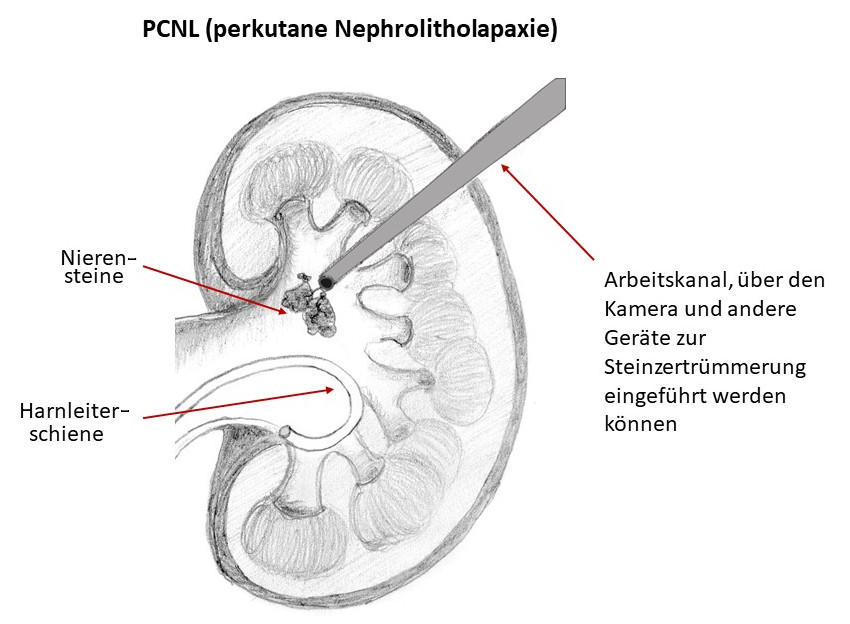 PCNL (perkutane Nephrolitholapaxie)