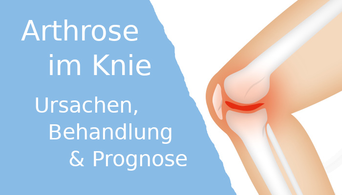 Arthrose im Knie