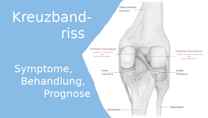 Kreuzbandriss: Symptome, Behandlung, Prognose