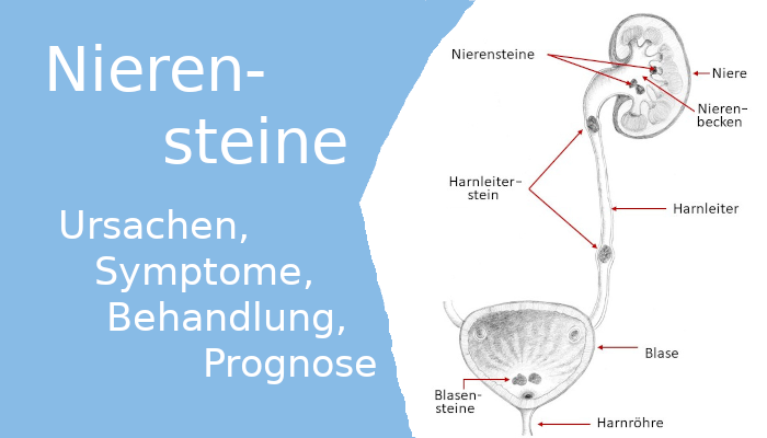 Nierensteine