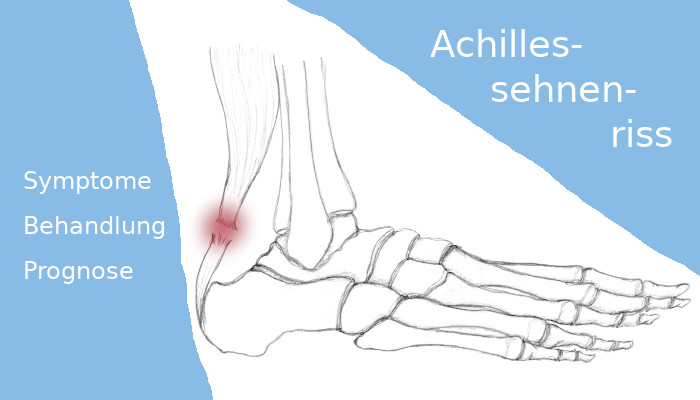 Sportverletzungen: Achillessehnenriss