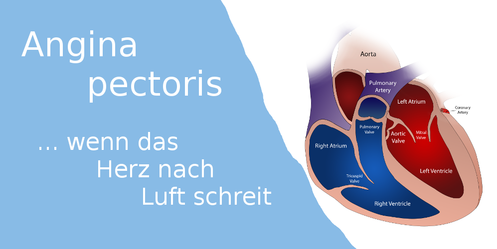 Angina pectoris: Symptome und Behandlung