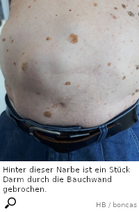 Narbenbruch kaiserschnitt Narbenbruch: Ursache,