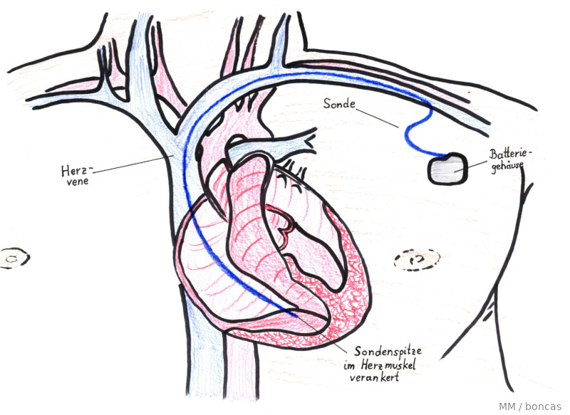 Defibrillator