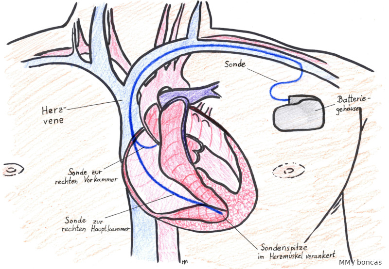 Herzschrittmacher