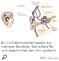 Cochlea-Implantat